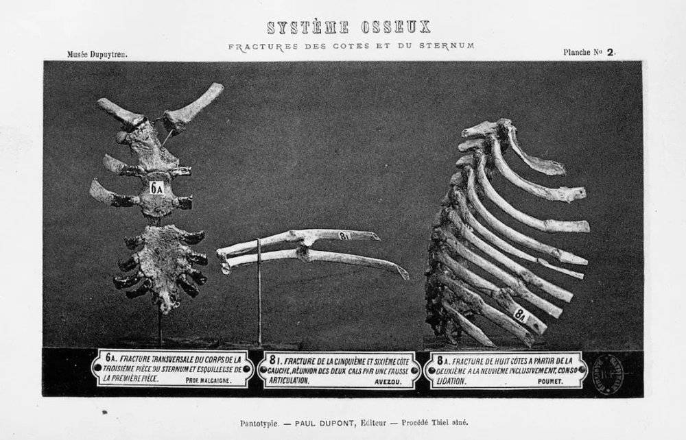 致命的横向胸骨骨折（藏品6A），它属于一位被马车撞倒的63岁男性；骨折的肋骨。照片选自夏尔-尼古拉·韦勒的《杜普伊特伦博物馆藏品目录》图集第一卷。© gallica.bnf.fr