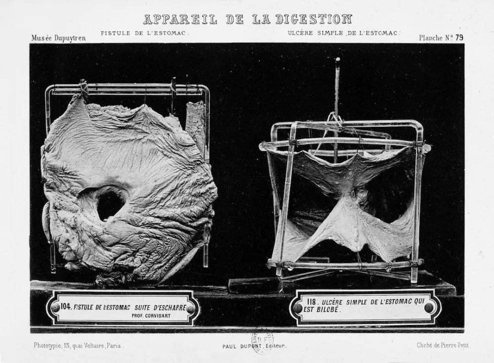一位名为戈蕾（Gorée）的40岁女性的胃瘘（藏品104），以及一个正在愈合的溃疡（藏品118）。照片选自夏尔-尼古拉·韦勒的《杜普伊特伦博物馆藏品目录》图集第四卷。© gallica.bnf.fr