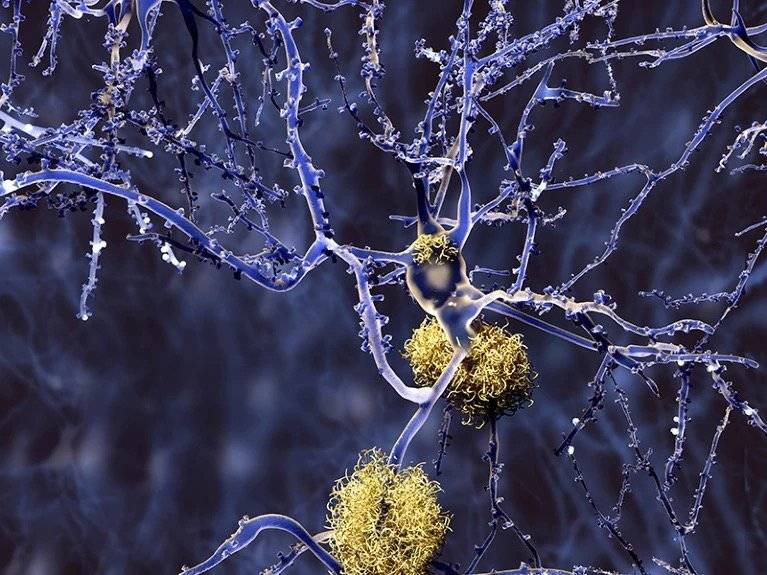 称为淀粉样斑块的蛋白质团块（金色，在该计算机插图中的蓝色神经元之间）是阿尔茨海默病的标志。图片来源：Juan Gaertner/Science Photo Library