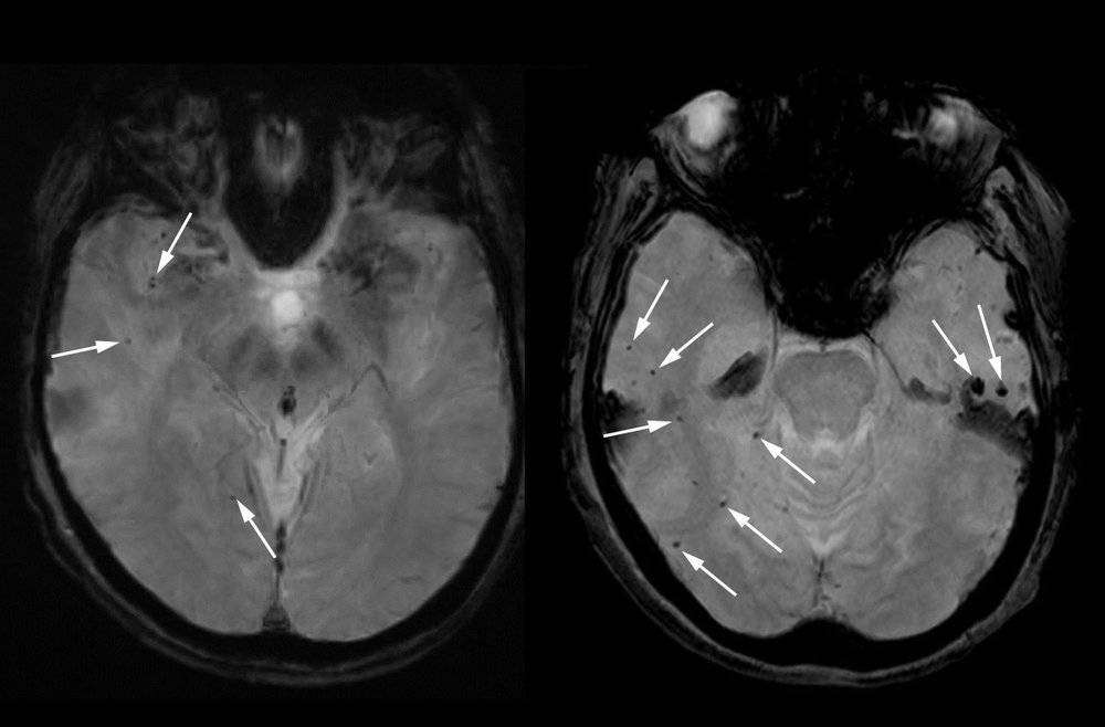 佛罗里达州一名妇女在临床试验中使用 lecanemab之前，她的大脑（左）的 MRI 扫描有一些微出血——微小的出血（黑点，用箭头标记）。之后（右），微出血更多且更明显（用箭头标记），图片来源：Science