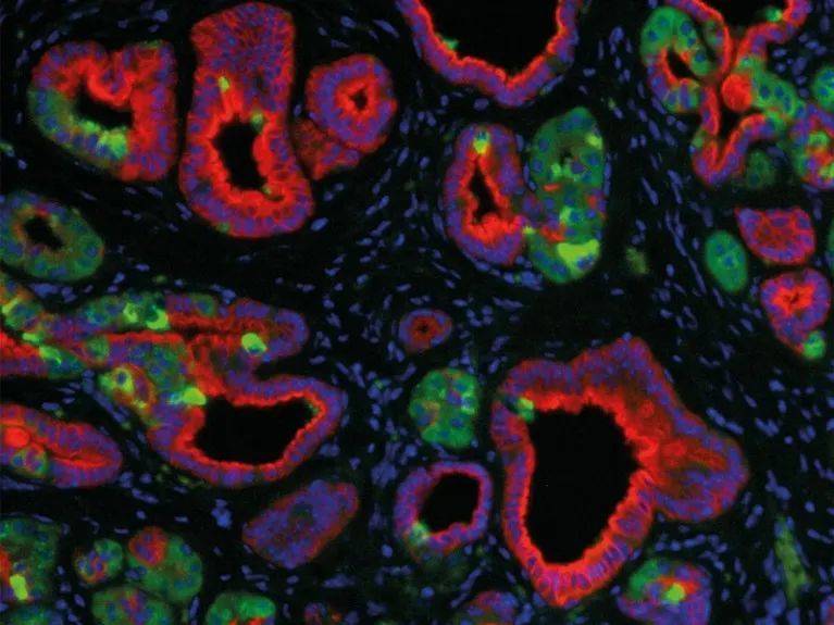 KRAS突变使小鼠胰腺的正常细胞（绿色）发生了癌前病变（红色）。来源：Maria Paz Zafra<br>