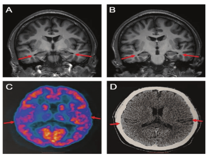 图片显示患者脑部存在轻度萎缩，源自Journal of Alzheimer's Disease<br>