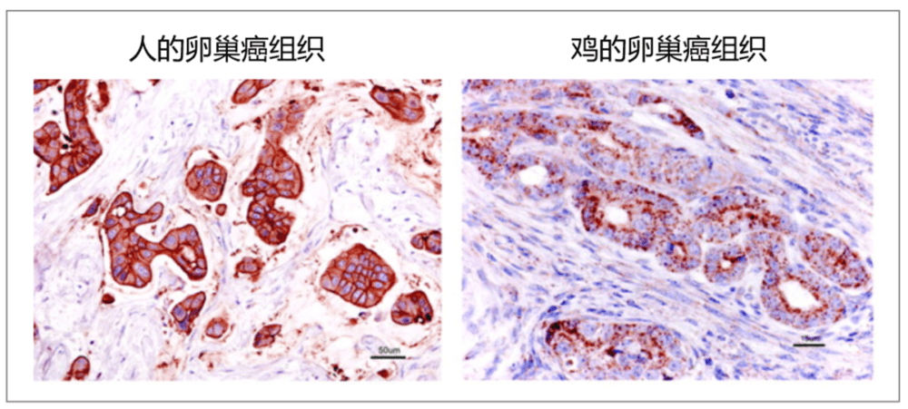 鸡和人的卵巢癌在显微镜下的对比<br>