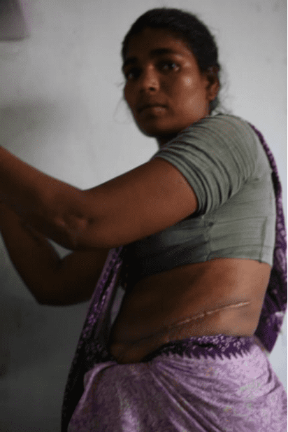 卡拉·阿鲁穆甘露出腹部的一条长疤痕，外科医生就是从这里摘取肾脏。虽然她在这张照片拍摄前几个月就动了手术，但是她仍然难以工作。她卖肾赚了一千美元。（图源：《人体交易》）<br>