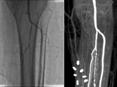 这是瓦茉·卡塔夏的血管造影照片，影像显示了她在印度金奈接受实验性干细胞疗法后的腿部已长出静脉，亮白色的条痕就是新的血管。要是疗法没有成功的话，医师就必须切除她的腿。此后，这种成功案例再未出现。<br>