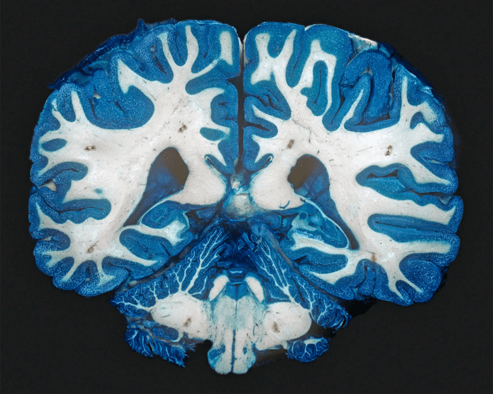 图注：研究表明，在慢性抑郁症患者的大脑中，富含神经纤维的“白质”区域的连接较少，而造成这种差异的原因未知。图片来源：Science<br>