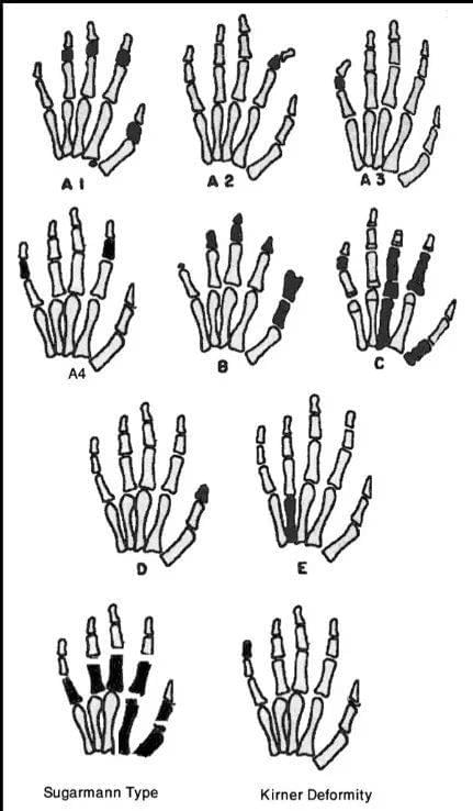 短指症是指手指骨短或缺失，手指短小只是表现之一。/图源网络