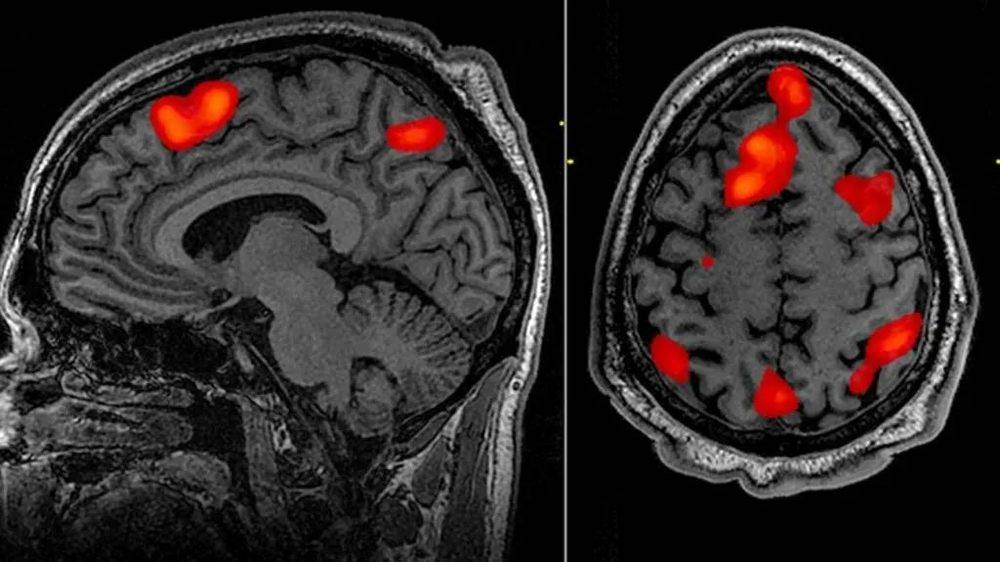 这是fMRI的图像，通过和静息状态的对比，研究者可以找到被激活的脑区（红色标记）<br>