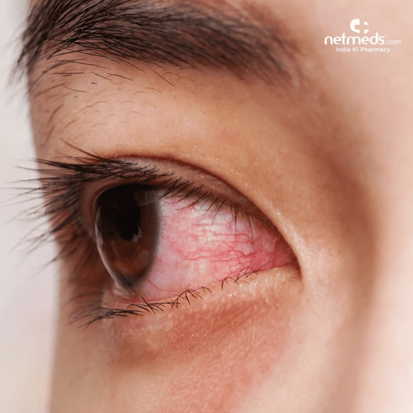 据了解，XBB.1.16可引起儿童眼睛发痒、发红（结膜炎），出现“粘眼”，非脓液。类似眼部症状在此前流行的新冠毒株感染病例中也有过报道。如果近期出现此类症状，应及时就医并在医生指导下进行治疗。图片来自：netmeds