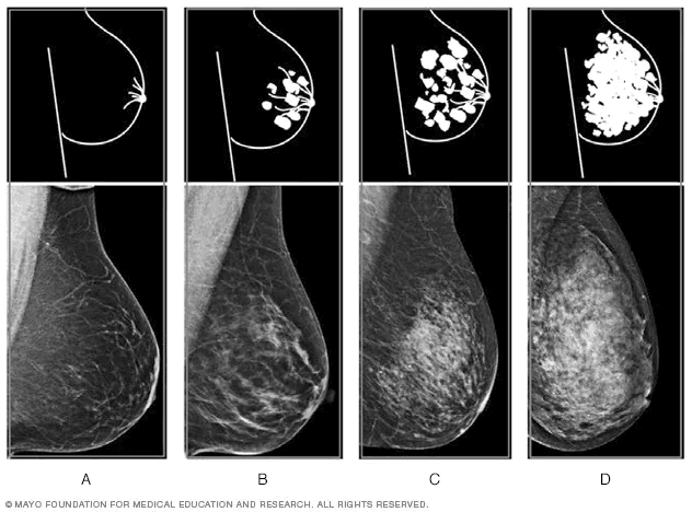 乳腺密度的4种水平丨mayoclinic.org<br>