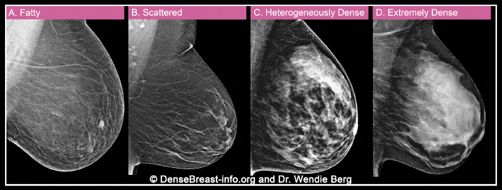 如该动图所示，乳腺密度越大，X线检查中癌症病灶被掩盖的风险就越高。丨DenseBreast-info.org and Dr. Wendie Berg<br>